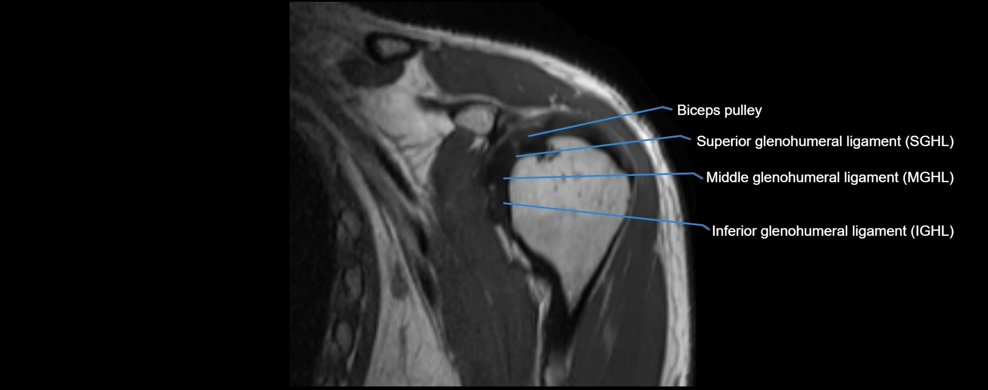 shoulder ligments coronal  cross sectional anatomy 3T MRI AI enhanced radiology image -img-00001-00011.webp